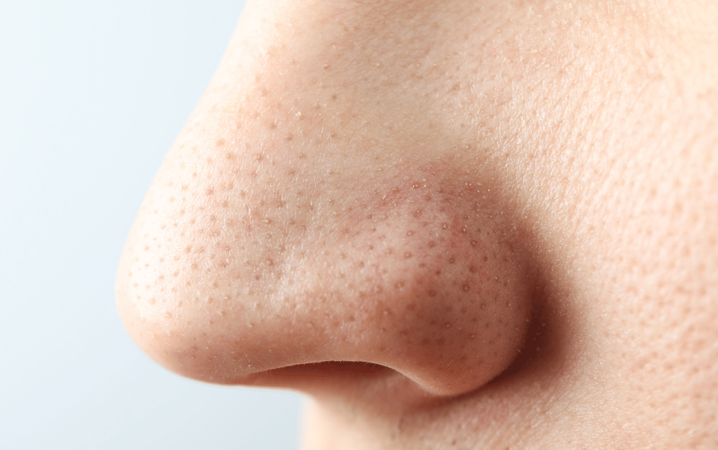 Non-surgical nose reshaping options